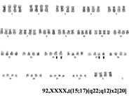 Paediatric acute promyelocytic leukemia with a tetraploid karyotype