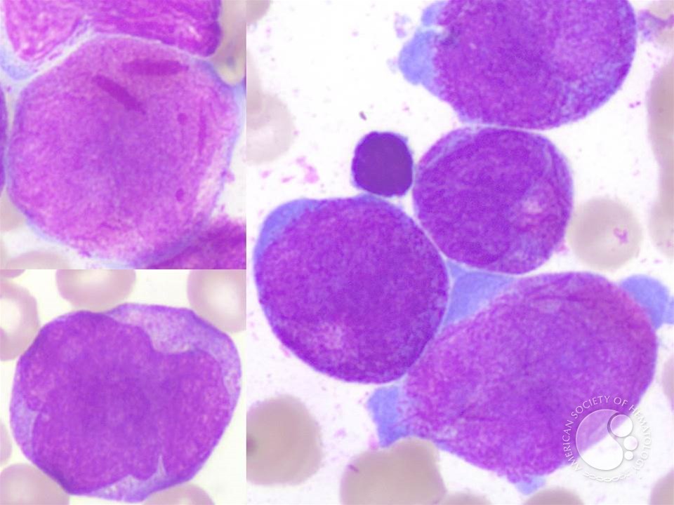Paediatric acute promyelocytic leukemia with a tetraploid Paediatric acute promyelocytic leukemia with a tetraploid