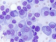 Multiple Myeloma - 2.