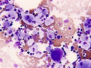 Morphology of Niemann-Pick type A metabolic storage disorder