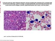 Cytoplasmic globules in erythroid blasts and CLL