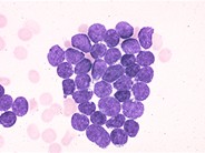 Precusor B-cell Acute Lymphoblastic Leukemia - 1.