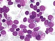 Precusor B-cell Acute Lymphoblastic Leukemia - 8.