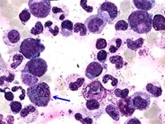 Acute Myeloid Leukemia with inv 16 - 1.