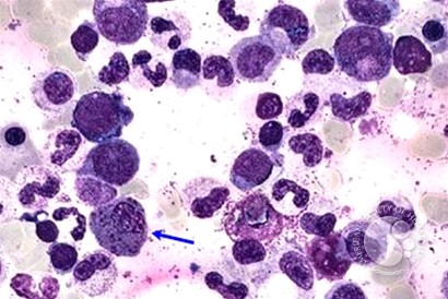 Acute Myeloid Leukemia with inv 16 - 1.