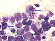 Acute Myeloid Leukemia with inv 16 - 2.