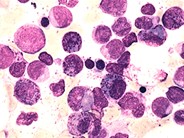 Acute Myeloid Leukemia with inv 16 - 3.