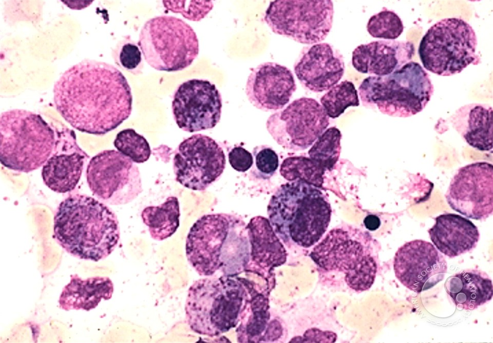 Acute Myeloid Leukemia with inv 16 - 3.