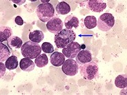 Acute Myeloid Leukemia Cells 5892