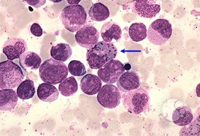 Acute Myeloid Leukemia with inv 16 - 4.