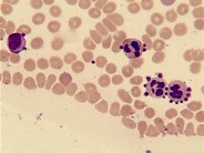 Pseudothrombocytopenia due to platelet satellitism