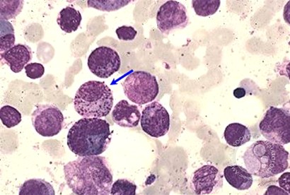 Acute Myeloid Leukemia with inv 16 - 5.