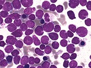 Precursor B-lymphoblastic Leukemia - 1.