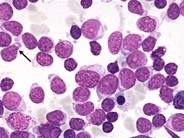 Precursor B-lymphoblastic Leukemia - 3.