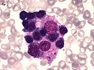 Hemophagocytosis - 1.