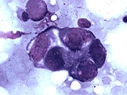 Metastatic Gastric Carcinoma - 1.