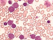 Hyperbasophilic Variant of Acute Promyelocytic Leukemia - 1.