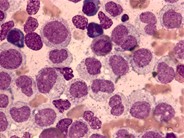 Microgranular Variant of Acute Promyelocytic Leukemia - 1.