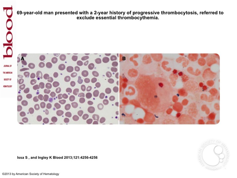 A case of refractory anemia with ring sideroblasts and associated thrombocytosis