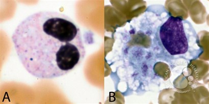 Transient Pelgeroid Change of Neutrophils in Hemophagocytic Lymphohistiocytosis