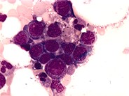 megaloblastic-anemia-1