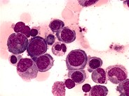 Клетки с гиперхромными ядрами. Мегалобластная анемия анемия. В12 мегалобластная анемия. В12-пернициозная анемия. Костный мозг при мегалобластной анемии.