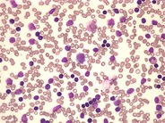 CLL - mixed cell type