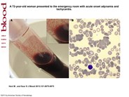 Blood clotting at room temperature in cold agglutinin disease