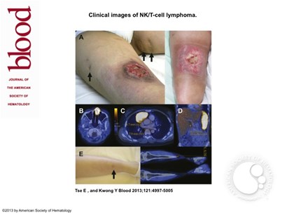 Clinical images of NK/T-cell lymphoma