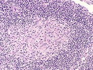 Angioimmunoblastic T Cell Lymphoma 11.