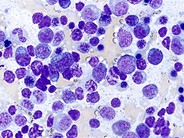 Angioimmunoblastic T Cell Lymphoma 8.