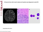 Isolated plasmacytoma involving the brain parenchyma and cerebral spinal fluid