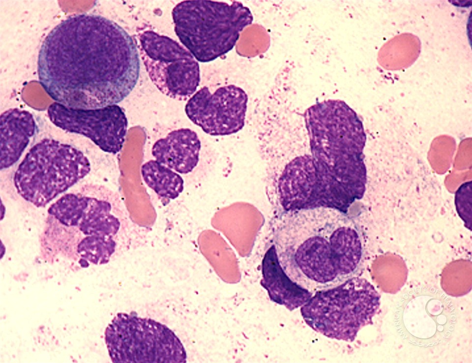 Acute Myeloid Leukemia with Maturation - 3.