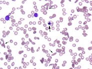 Aplastic Crisis in a Patient with Sickle Cell Disease - 1.