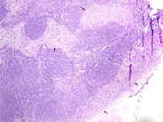 Diffuse Large B-cell Lymphoma, Anaplastic Variant - 1.