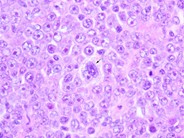 Diffuse Large B Cell Lymphoma Anaplastic Variant 3
