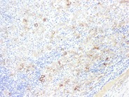 Diffuse Large B-cell Lymphoma, Anaplastic Variant - 5.