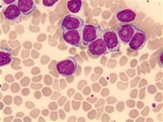 Лимфобласты в крови фото под микроскопом