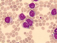 prolymphocytes