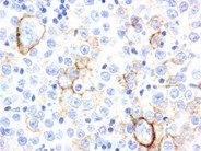 Diffuse Large B-cell Lymphoma, Anaplastic Variant - 7.