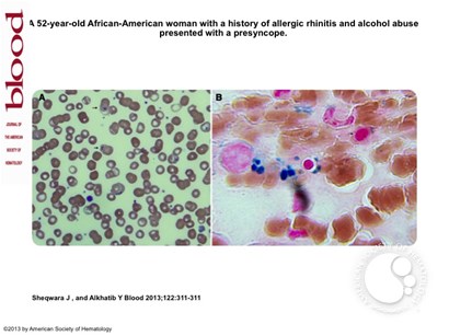 Sideroblastic anemia secondary to zinc toxicity