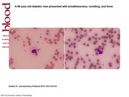 Massive intravascular hemolysis with organ failure due to Clostridium perfringens: evidence of intracytoplasmic C. perfringens