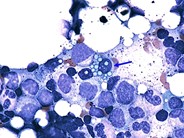 Multiple Myeloma - 5.