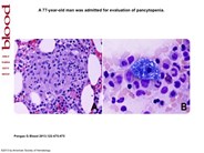 Sea-blue–colored histiocytes associated with bone marrow granulomas