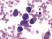 Hypergranulated Acute Promyelocytic Leukemia - 1.