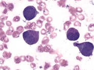 Hypergranulated Acute Promyelocytic Leukemia - 3.