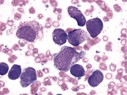 Hypergranulated Acute Promyelocytic Leukemia - 4.