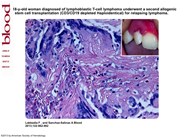 Invasive mucormycosis without radiological alterations