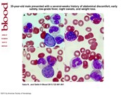 A myeloproliferative neoplasm with translocation t(8;9)(p22;p24) involving JAK2 gene