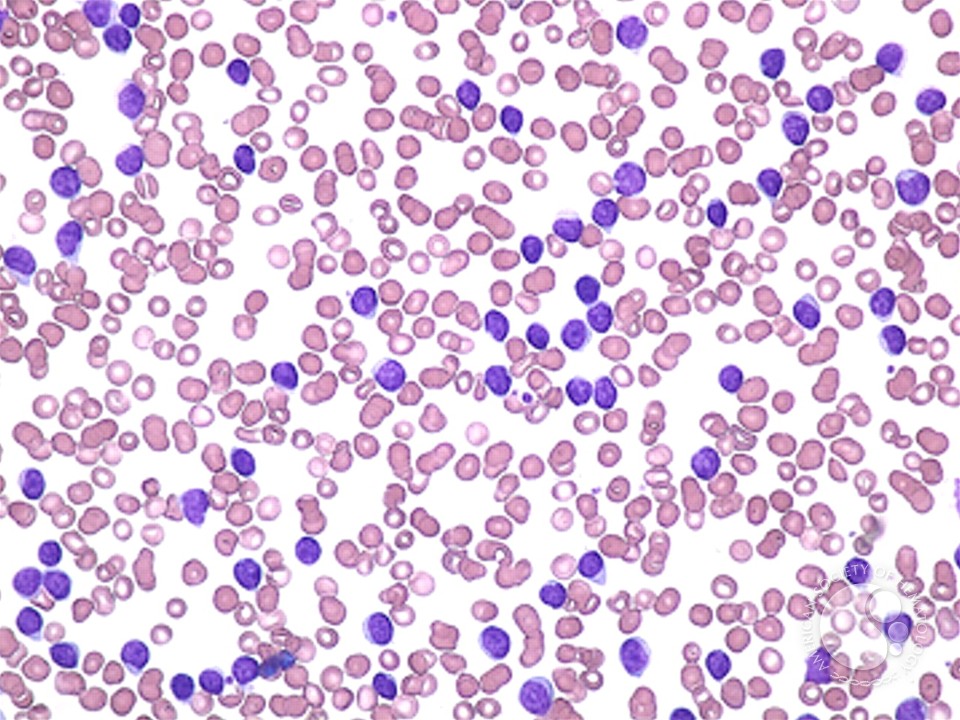 Кровь на б клетки. Хронический лимфолейкоз микроскопия. Клетки лейколиза (тени Боткина-Гумпрехта). Миелоцитарный и лимфоцитарный лейкоз что это. Клетки Боткина Гумпрехта это.